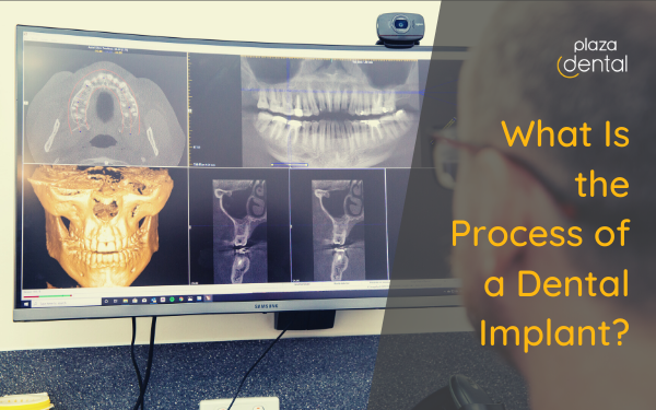 What Is the Process of a Dental Implant?