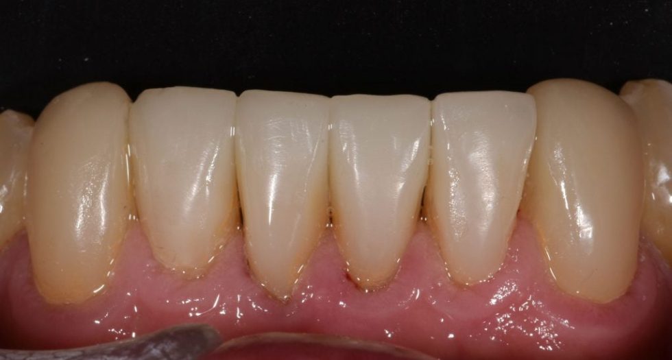 Get a Dental Crown in One Visit Plaza Dental