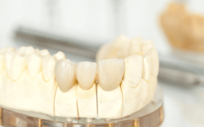 What Is the Cost of Dental Crown ?