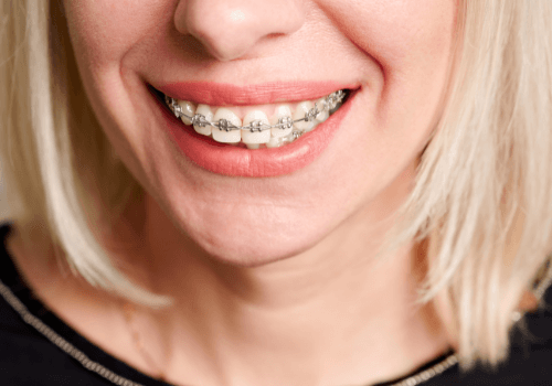 Cost of Orthodontic Treatment  - Mackay - Plaza Dental