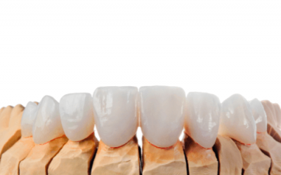 What Are the Different Types of Veneers?