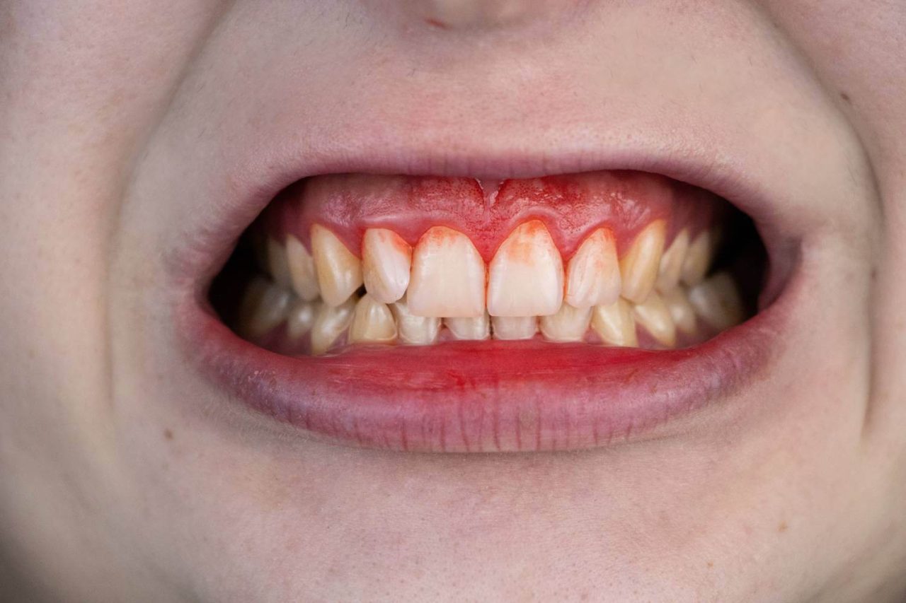 Swollen Gums What Lies Beneath The Inflammation? Plaza Dental