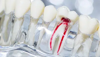 Root Canal Therapy