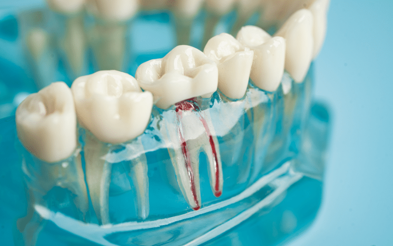 Root Canal Treatment: Is It As Painful As It Sounds?