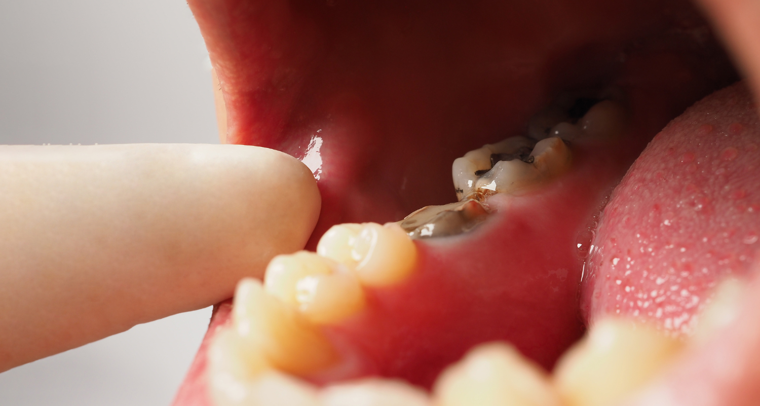 Root Canal Symptoms: Warning Signs Your Tooth Is Crying Out for Help