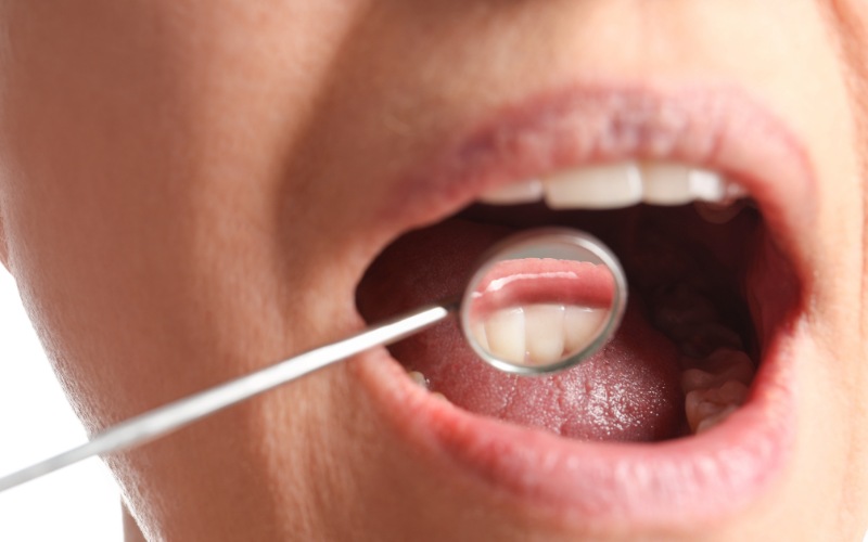 Understanding Bone Graft for Implants – When Is Bone Grafting Needed?